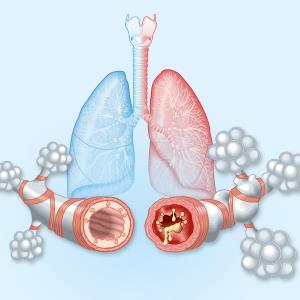 Tezepelumab reduces mucus plugging in patients with asthma