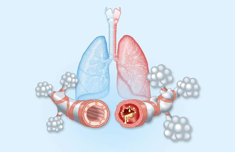 Tezepelumab reduces mucus plugging in patients with asthma