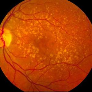 OPT-302 2.0 mg plus ranibizumab leads to superior vision gains in nAMD