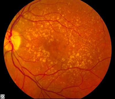 The bright spots in this human eye scan are signs of macular degeneration. Photo credit: National Eye Institute