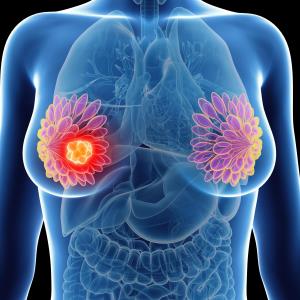 Recurrent node-positive breast cancer reveals distant metastasis in patients