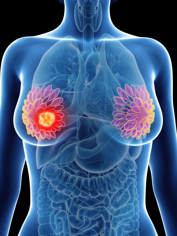 Recurrent node-positive breast cancer reveals distant metastasis in patients