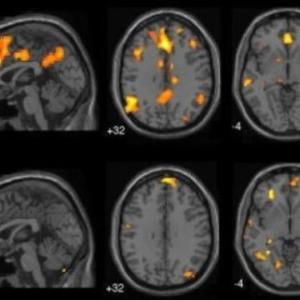 Brain network architecture changes linked to trauma-related dissociation