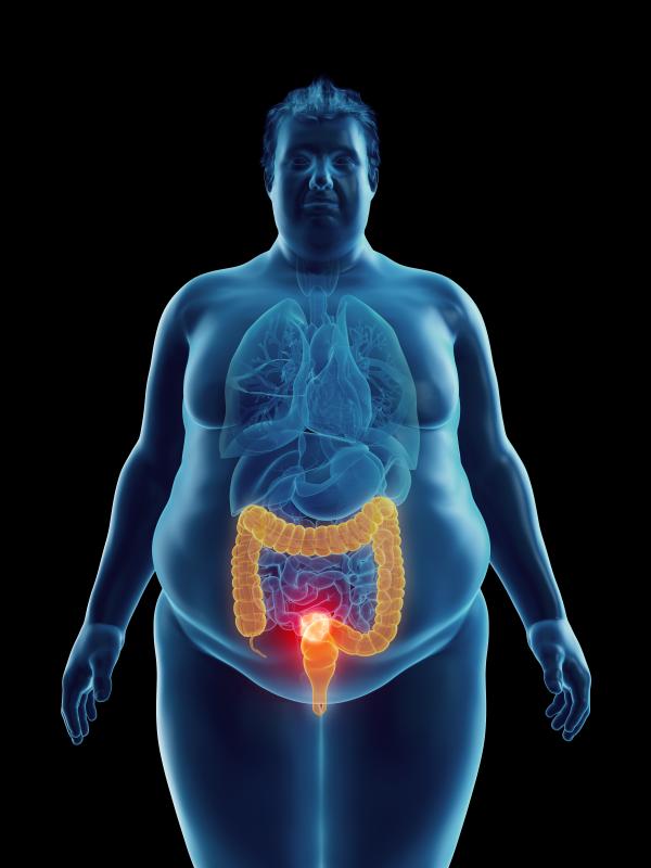 Does obesity reduce risk of death in cancer patients?