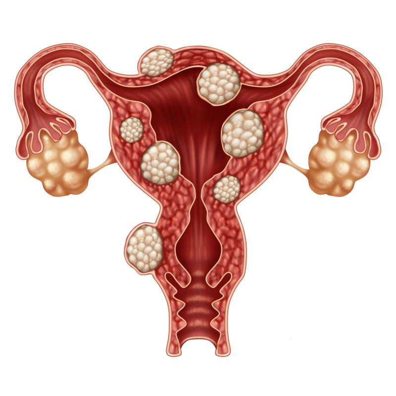 Relugolix relieves pain symptoms in women with uterine fibroids