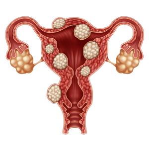 Erythrocyte membrane fatty acid concentration may hold clues to fibroid risk