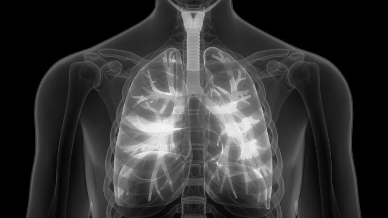 Lung ultrasound helps rule out ILD in patients with RA