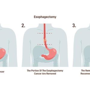 Thoracoscopic esophagectomy better than open surgery in esophageal cancer