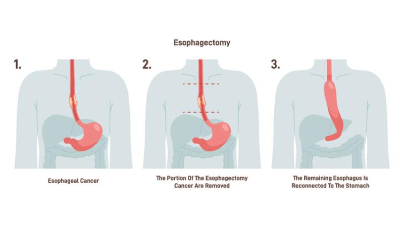 Thoracoscopic esophagectomy tied to better survival than open surgery for esophageal cancer