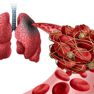 Right heart thrombus with pulmonary embolism tied to poor survival, ICU admission