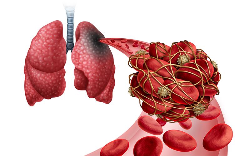 Right heart thrombus with pulmonary embolism tied to poor survival, ICU admission