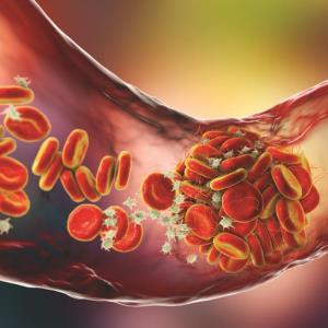 Thromboembolism rate lower than expected in Chinese patients with pancreatic cancer