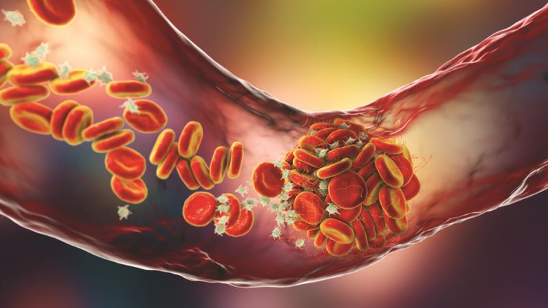 Thromboembolism rate lower than expected in Chinese patients with pancreatic cancer