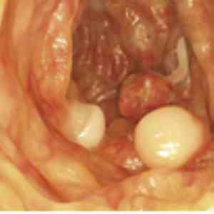 Endoscopic submucosal dissection effective for colorectal polyp regardless of lesion size