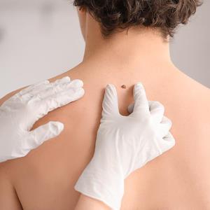 TIL therapy still effective in advanced melanoma despite prior anti-PD-(L)1 treatment