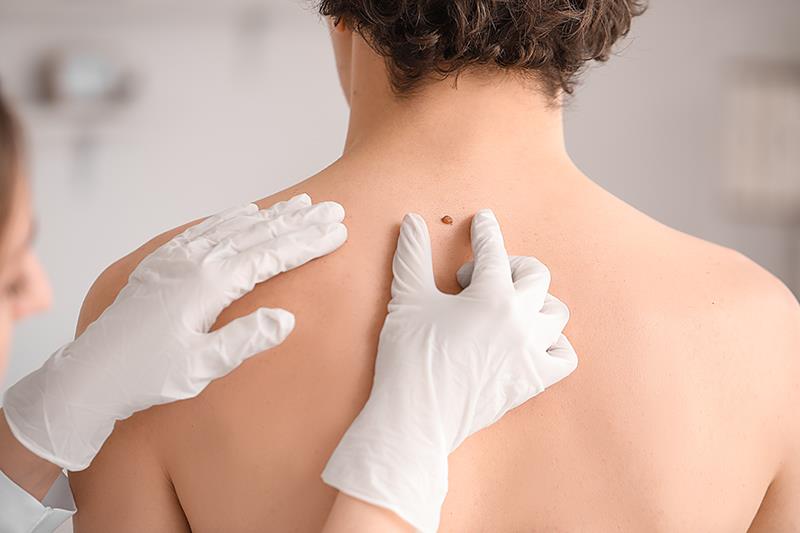 TIL therapy still effective in advanced melanoma despite prior anti-PD-(L)1 treatment