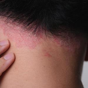 Home-based as good as office-based phototherapy for psoriasis