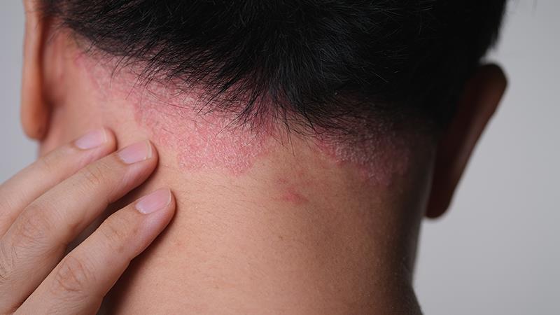 Home-based as good as office-based phototherapy for psoriasis