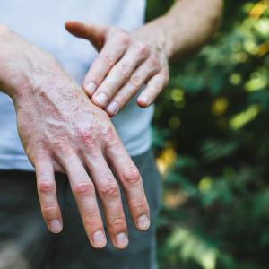 Psoriasis tied to highest liver disease risk relative to PsA, RA