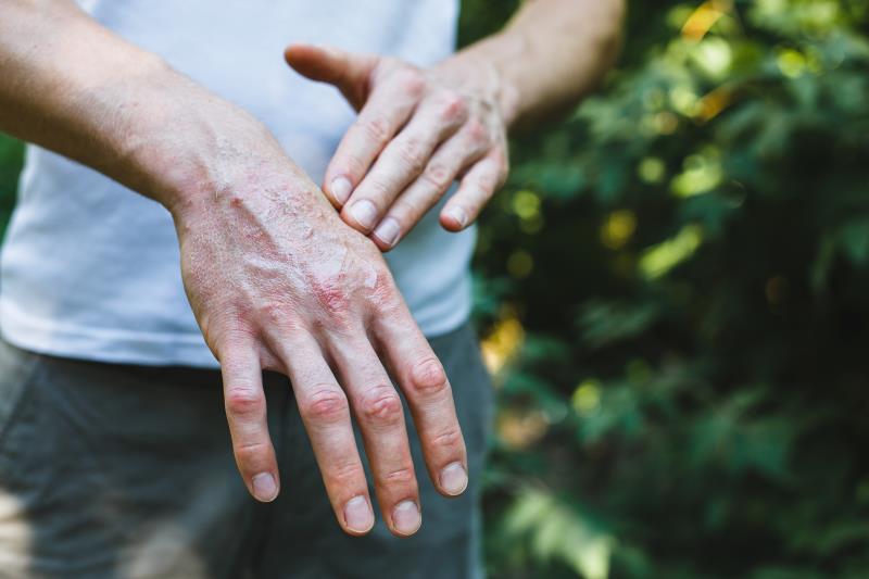 Psoriasis tied to highest liver disease risk relative to PsA, RA