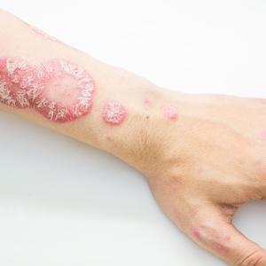 Ustekinumab use common in psoriasis