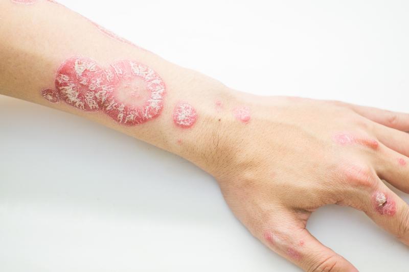 Ustekinumab use common in psoriasis