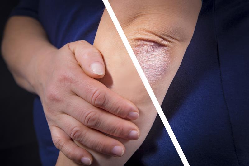 Zasocitinib shows promise as psoriasis treatment