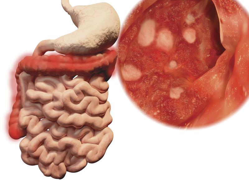 Maintenance apheresis safe for ulcerative colitis patients