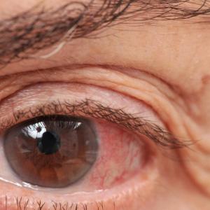 Calcium-channel blocker use ups glaucoma prevalence