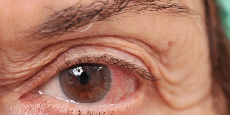 Calcium-channel blocker use ups glaucoma prevalence