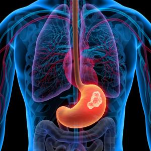 Ramucirumab plus paclitaxel prolongs survival in metastatic gastric/lower oesophageal cancer