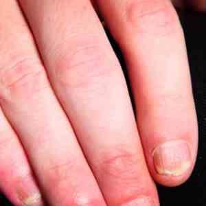 Which medication is most effective for nail psoriasis?