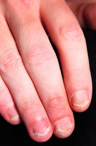 Which medication is most effective for nail psoriasis?