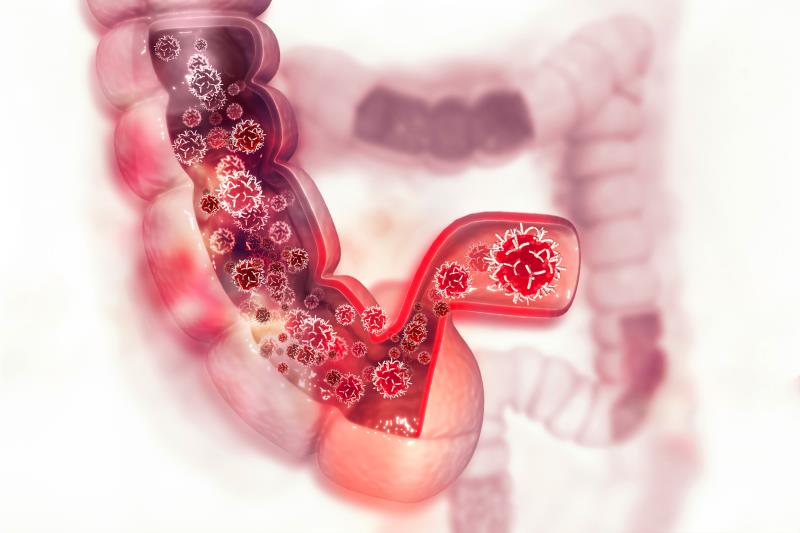 FOLFOX/XELOX improves survival, response rate in CRC patients with DDR-mutated tumour