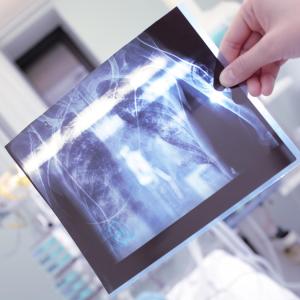 RA-related factors may contribute to higher TB risk