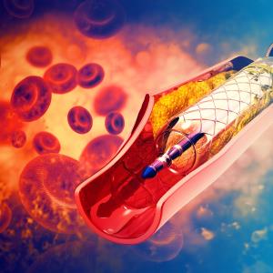 Ticagrelor monotherapy outshines DAPT after complex PCI