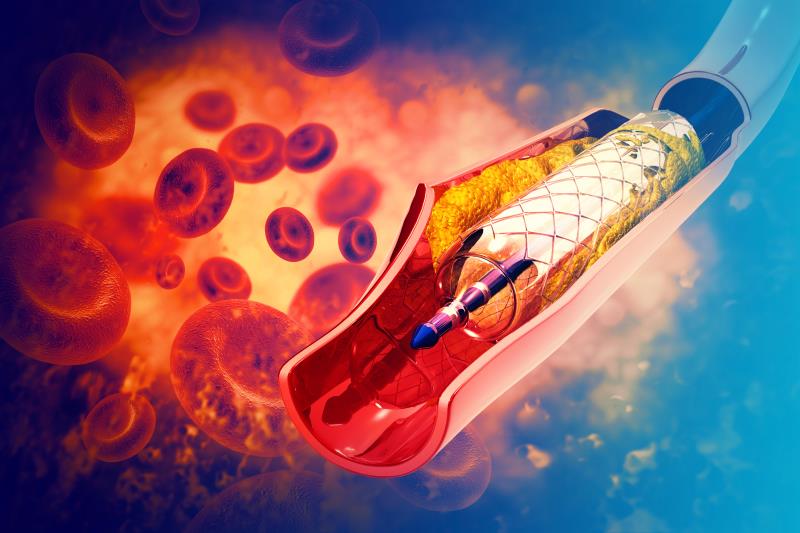 Ticagrelor monotherapy outshines DAPT after complex PCI