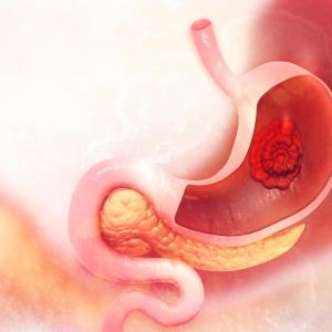 H pylori treatment, vitamin and garlic supplementation may reduce gastric cancer mortality