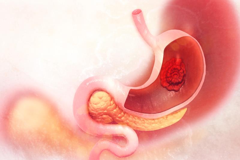 H pylori treatment, vitamin and garlic supplementation may reduce gastric cancer mortality