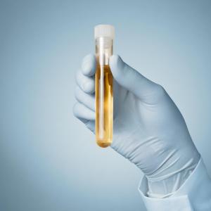 Positive urine culture tied to postsurgery infections