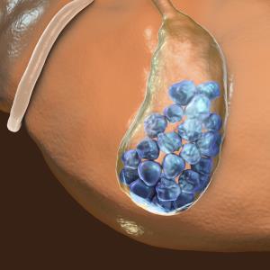 Ursodeoxycholic acid may prevent post-gastrectomy gallstones in gastric cancer