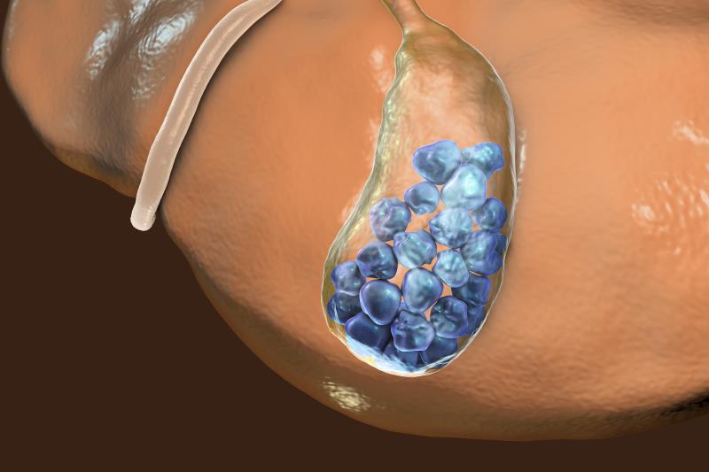 Ursodeoxycholic acid may prevent post-gastrectomy gallstones in gastric cancer