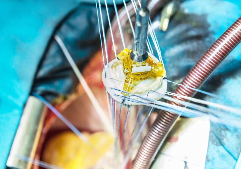 Redo-TAVR a safe, effective option for patients with valve dysfunction