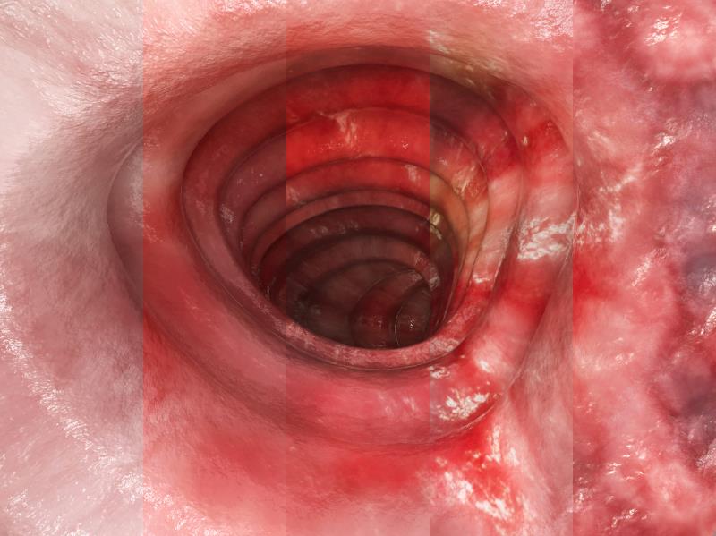 SC vedolizumab improves outcomes in patients with Crohn’s disease