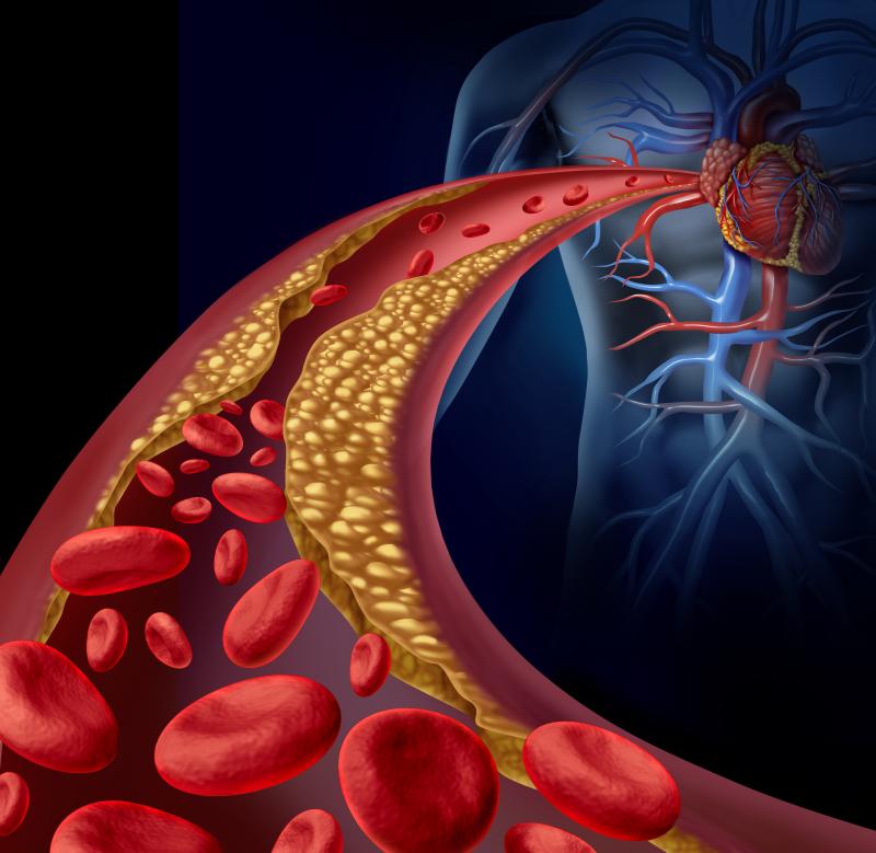 LDL-C levels do not predict ischaemic stroke in AF patients on DOACs