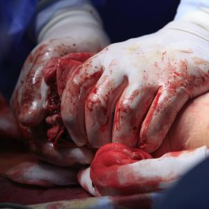 Stopping bleeding after trauma: VHA no better than CCT