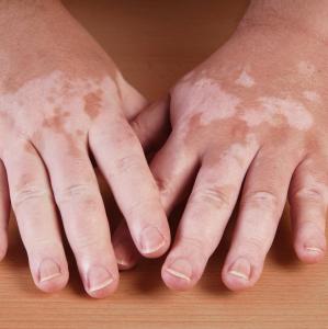 No clear link between multiple sclerosis, vitiligo