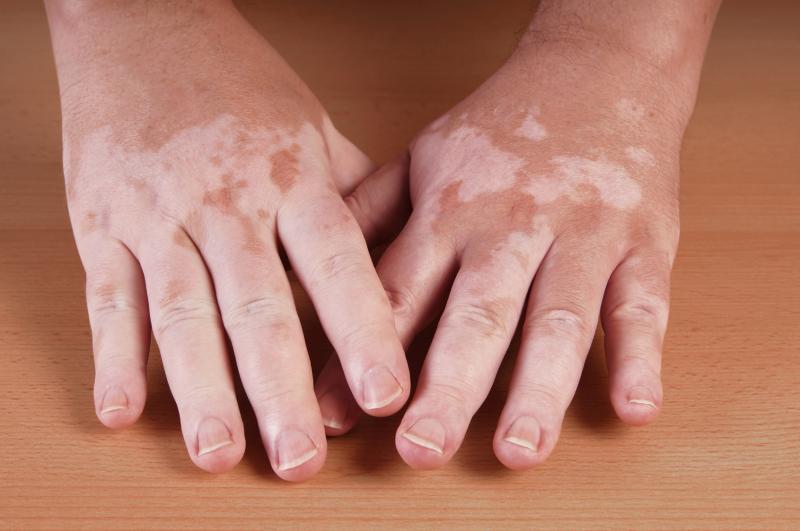 Treating vitiligo through arthritis drug