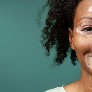 Oral ritlecitinib shows promise against nonsegmental vitiligo