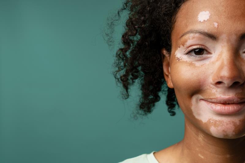 Oral ritlecitinib shows promise against nonsegmental vitiligo